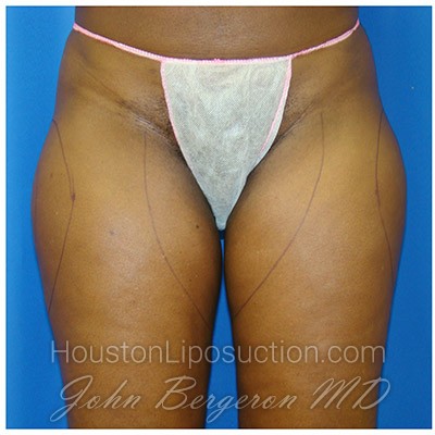 Liposuction before photo