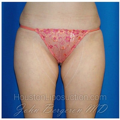 Liposuction before photo
