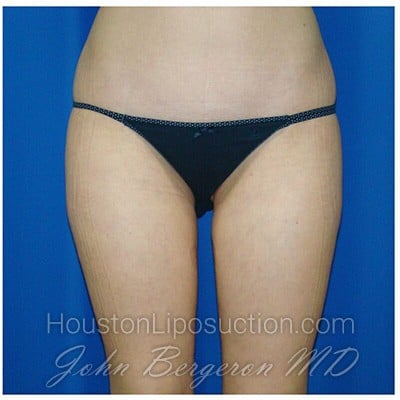 Liposuction after photo