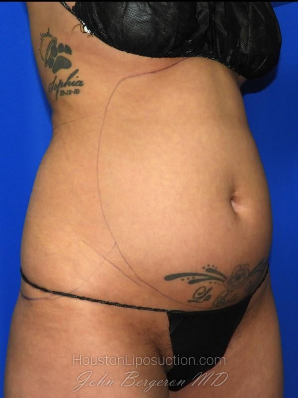 Liposuction before photo