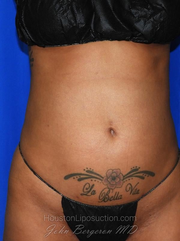 Liposuction after photo