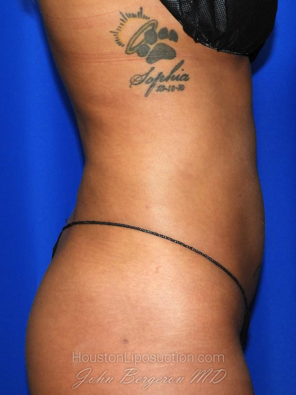 Liposuction after photo