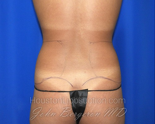 Liposuction before photo