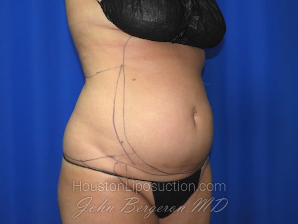 Liposuction before photo