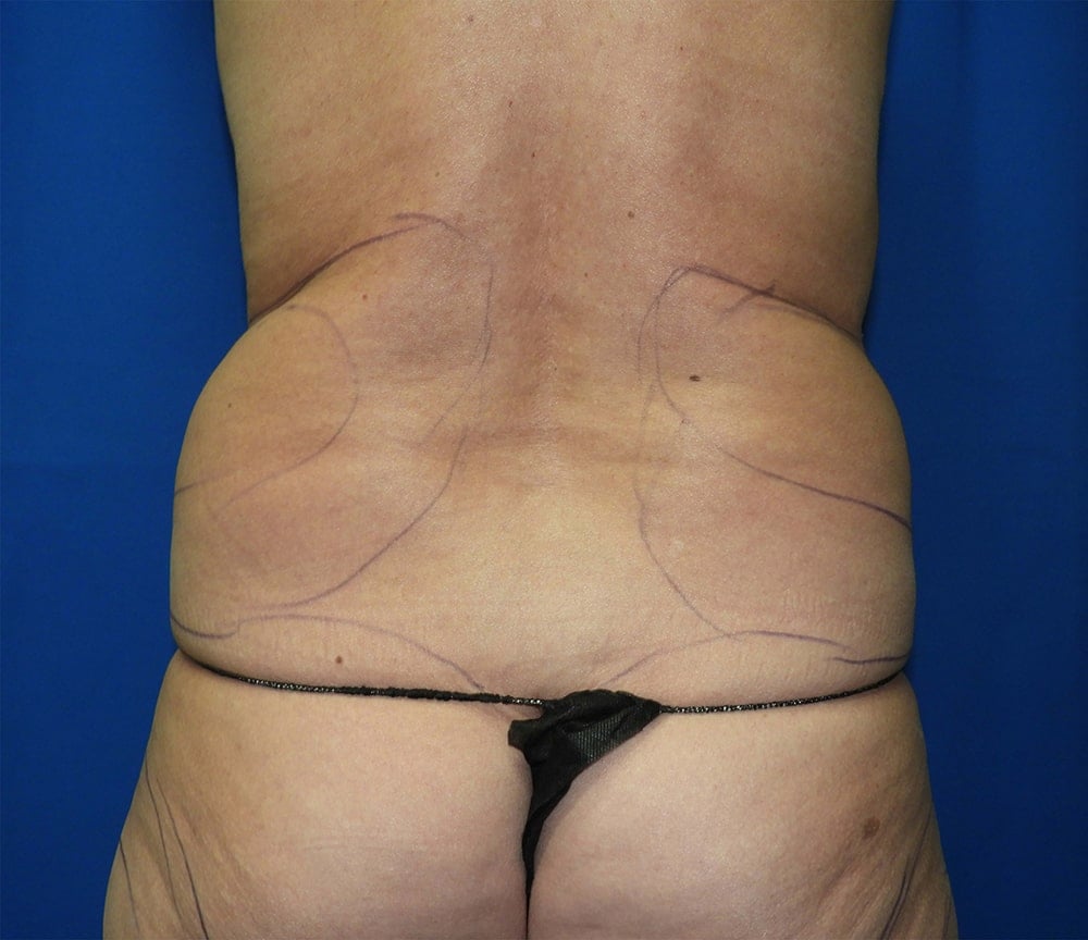 Liposuction before photo