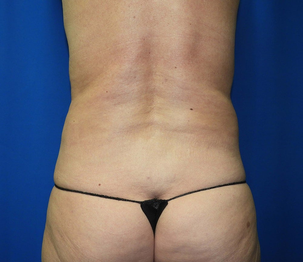 Liposuction after photo