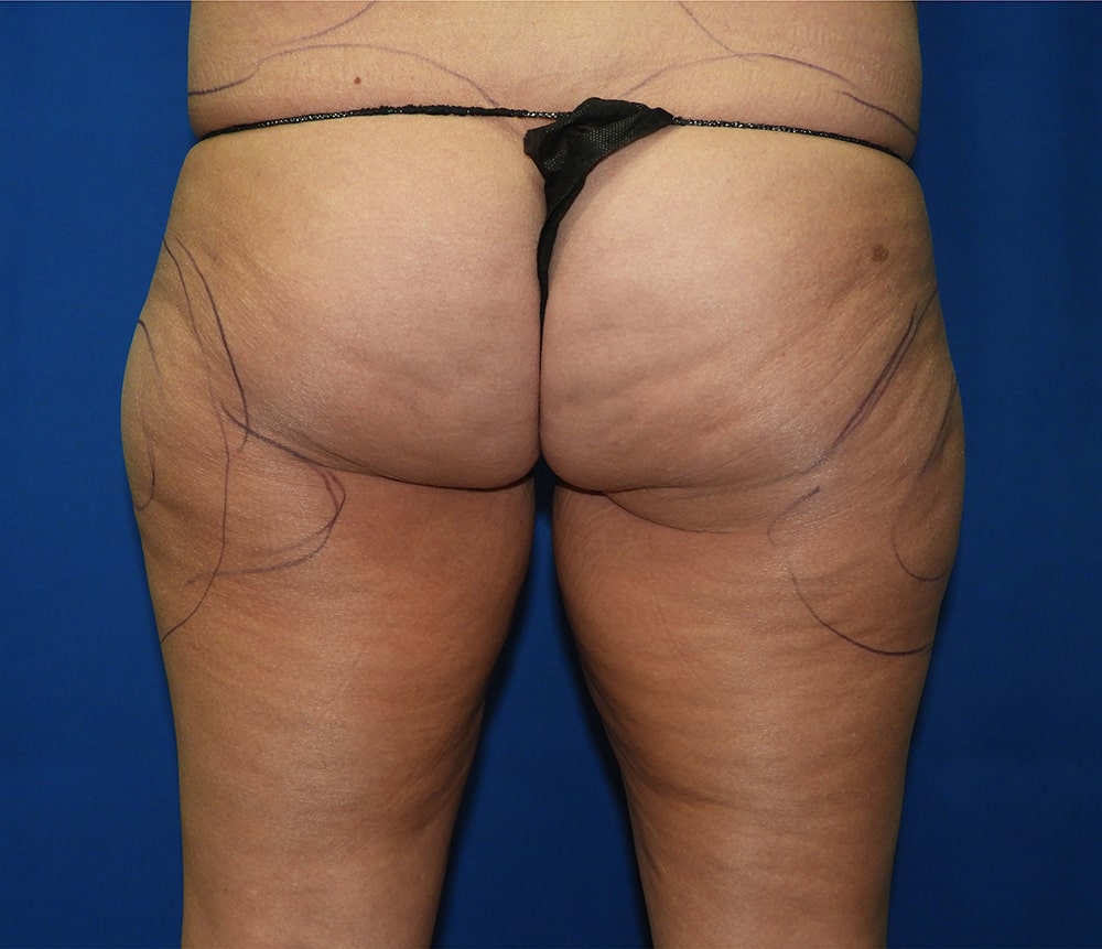 Liposuction before photo