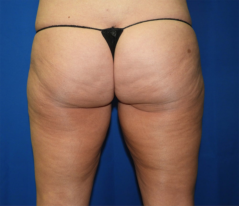 Liposuction after photo
