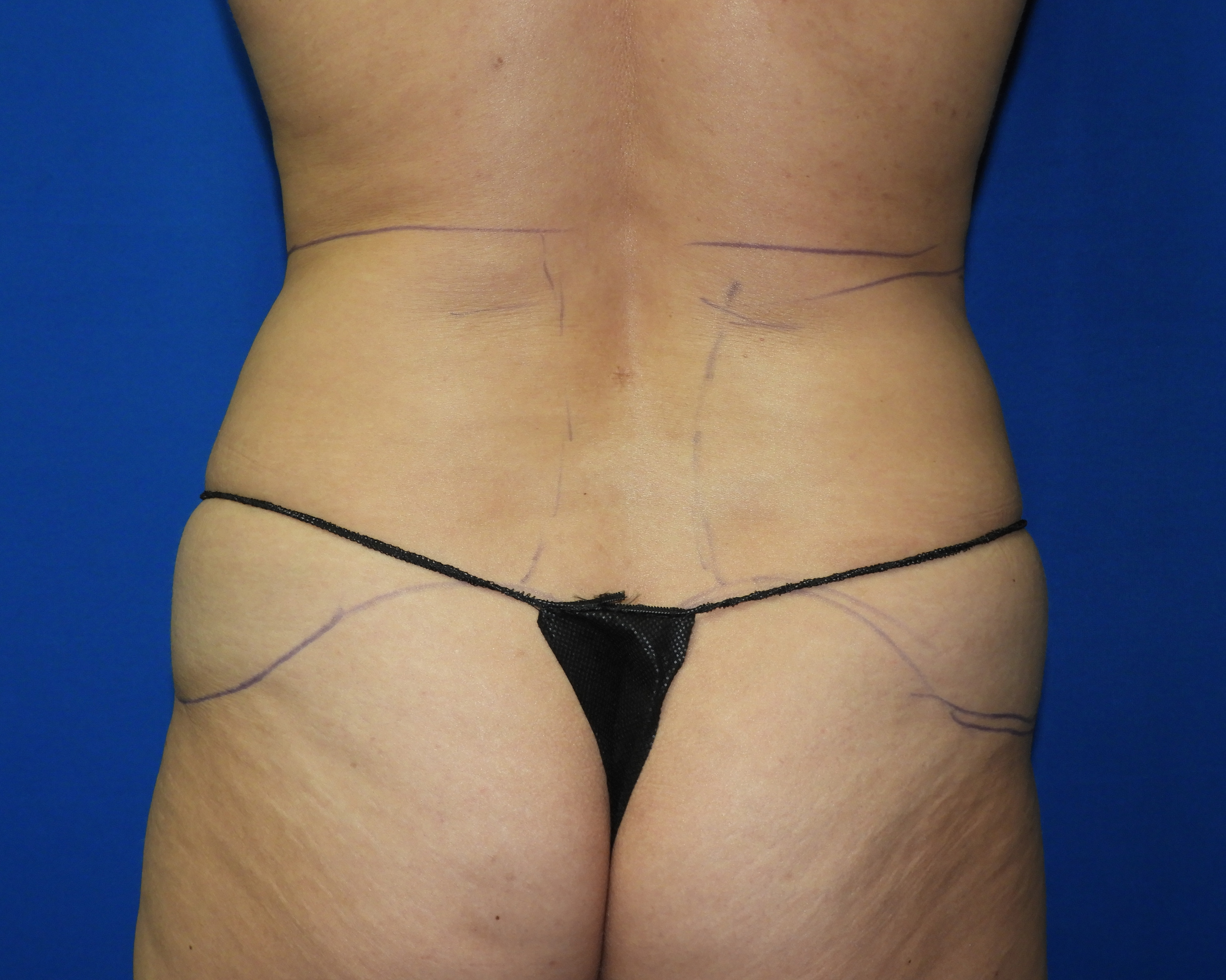Liposuction before photo