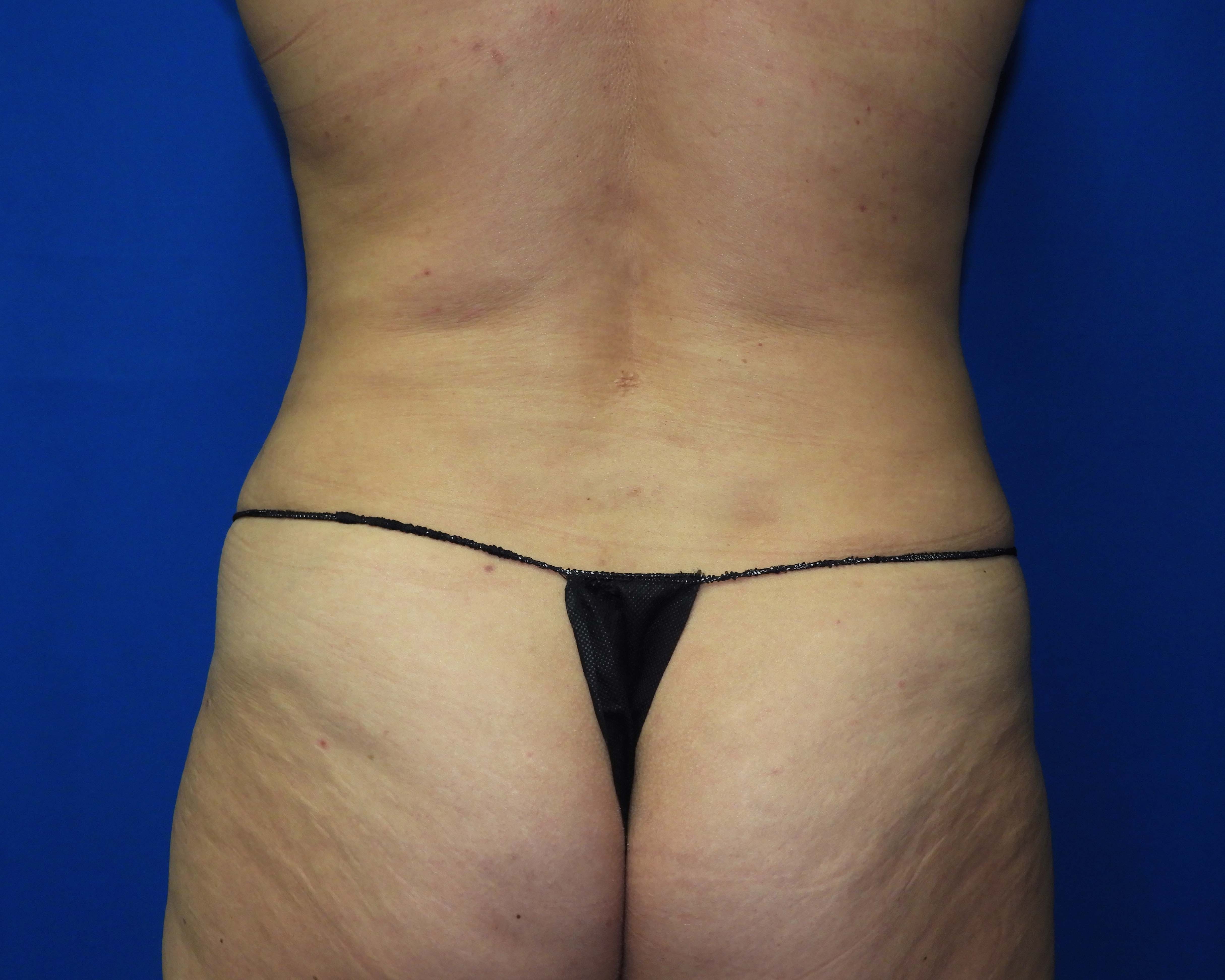 Liposuction after photo
