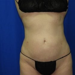Liposuction after photo