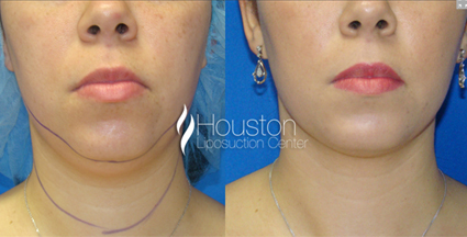 chin-liposuction