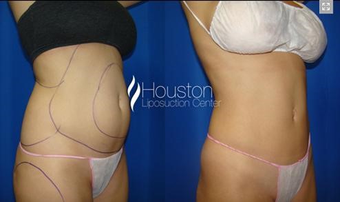 abdominal-smartlipo