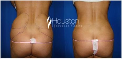 Love handles on sale and muffin top