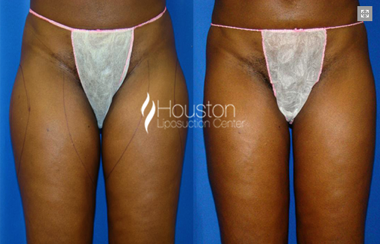 thighs-liposuction-smartlipo