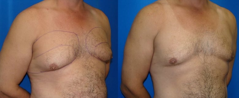 gynecomastia-liposuction