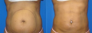 abdominal-smartlipo-300x108