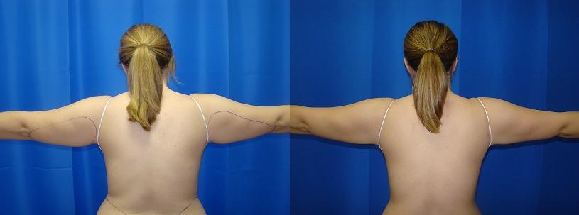 arm-liposuction-blog