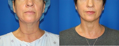 neck-lipo-houston