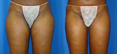 Smartlipo-thigh-before-and-after