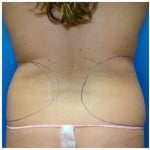 Liposuction Before & After Patient #267