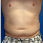 Liposuction Before & After Patient #303