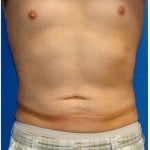 Liposuction Before & After Patient #303