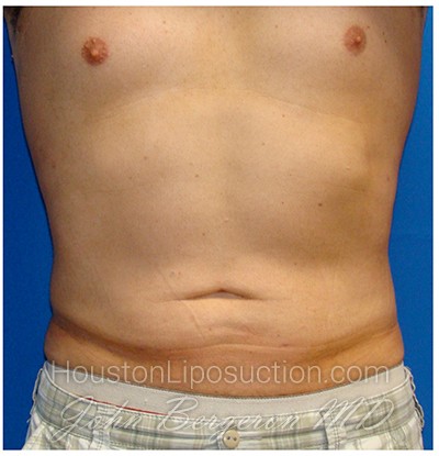 Liposuction Before & After Patient #303