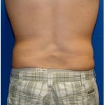 Liposuction Before & After Patient #303