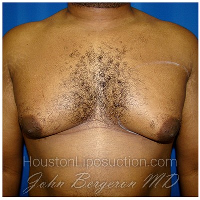 Liposuction Before & After Patient #344