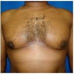 Liposuction Before & After Patient #344