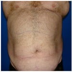 Liposuction Before & After Patient #359