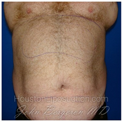 Liposuction Before & After Patient #359