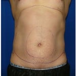 Liposuction Before & After Patient #399