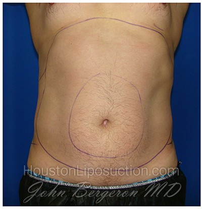 Liposuction Before & After Patient #399