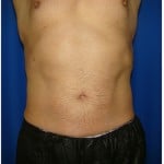 Liposuction Before & After Patient #399