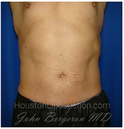 Liposuction Before & After Patient #399