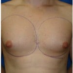 Liposuction Before & After Patient #432