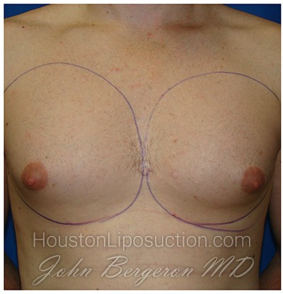 Liposuction Before & After Patient #432