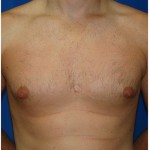 Liposuction Before & After Patient #432