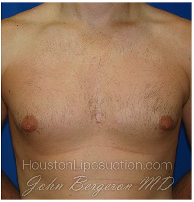 Liposuction Before & After Patient #432