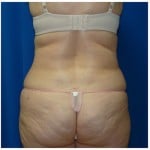 Liposuction Before & After Patient #429