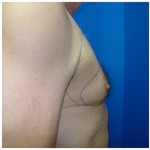 Liposuction Before & After Patient #297