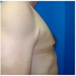 Liposuction Before & After Patient #297