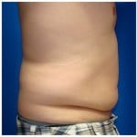 Liposuction Before & After Patient #303