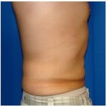 Liposuction Before & After Patient #303