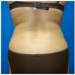 Liposuction Before & After Patient #309