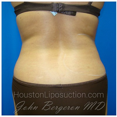 Liposuction Before & After Patient #309