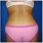 Liposuction Before & After Patient #309