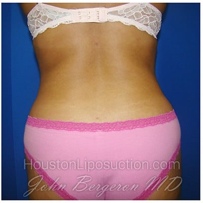 Liposuction Before & After Patient #309